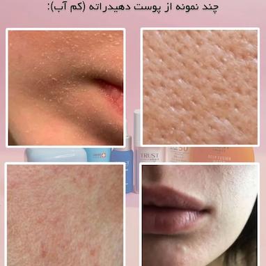 فرق پوست خشک و پوست دهیدراته چیست؟